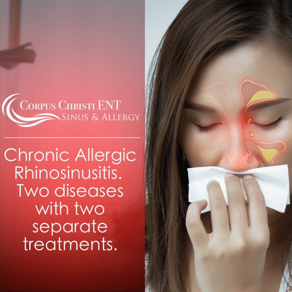 Chronic Allergic Rhinosinusitis Two Diseases With Two Separate Treatments Corpus Christi Ent 0666