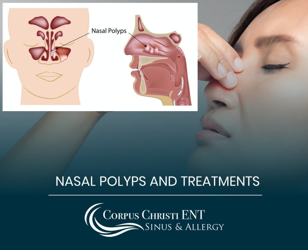 What Are Nasal Polyps? – Corpus Christi ENT Sinus & Allergy