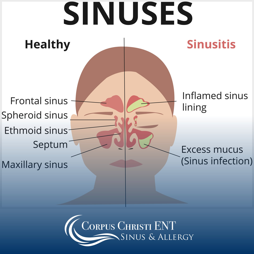 Chronic Sinus Infections | When to Treat Sinusitis | Corpus Christi, TX